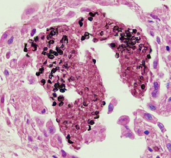 Imagen: Quistes de Pneumocystis jirovecii en tejido pulmonar (Fotografía de los Centros para el Control de Enfermedades de los EUA) 